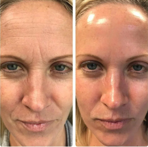 EMS Facial Pro